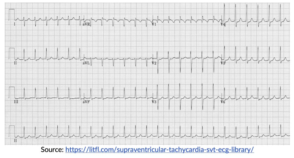 Supraventricular Tachycardia SVT ECG 